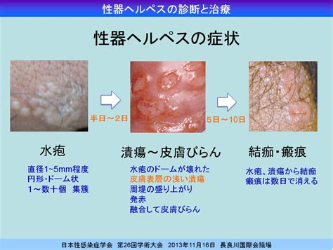 クリトリスにできもの|女性器周辺や外陰部「かゆみ・はれ・痛み・できもの」